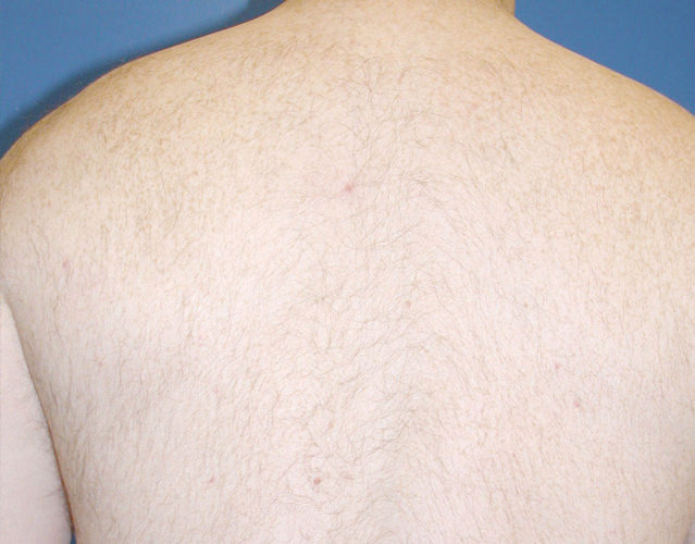 hair_removal_back_after