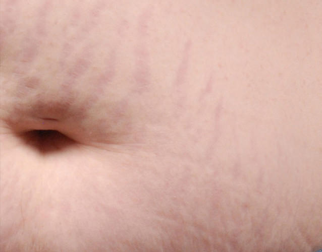stretch_mark_removal_stomach_3_before