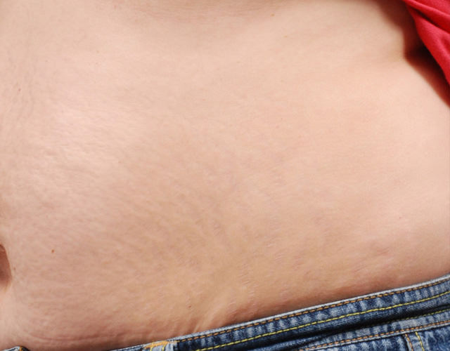 stretch_mark_removal_stomach_after